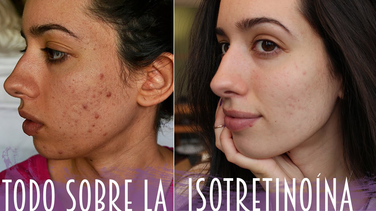 precio pastillas isotretinoina