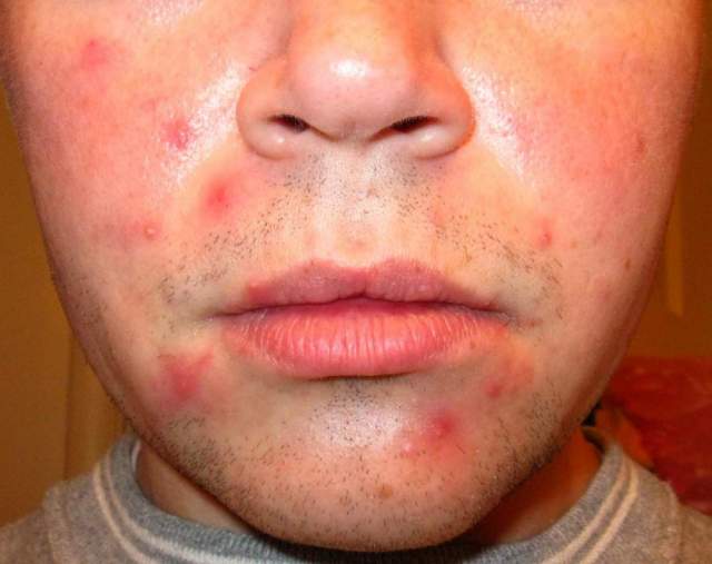 roaccutane 30mg online