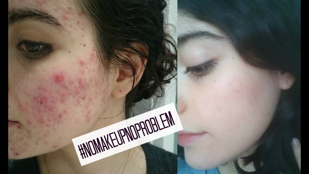 cómo comprar isotretinoina