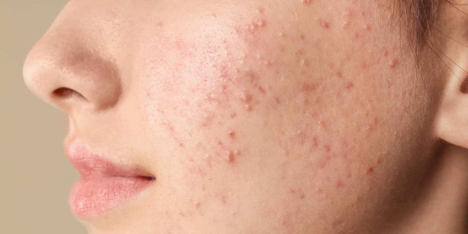 Isotretinoina España