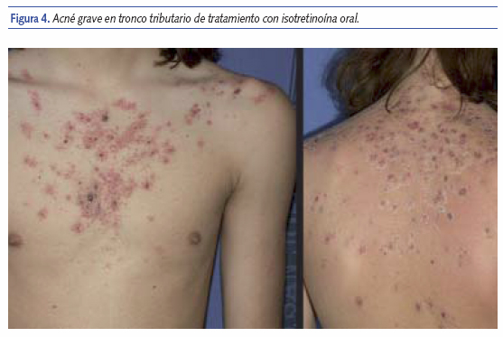 isotretinoina precio españa seguridad social