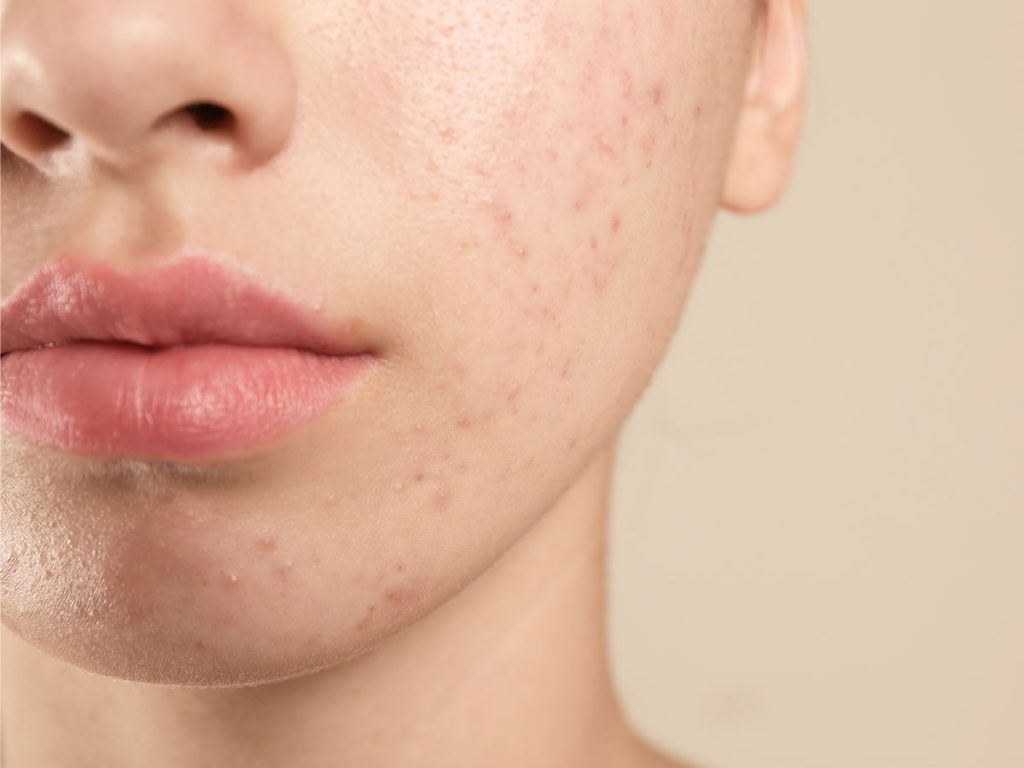 Roacutan Precio En Farmacias