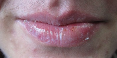 Isotretinoina vastionin precio