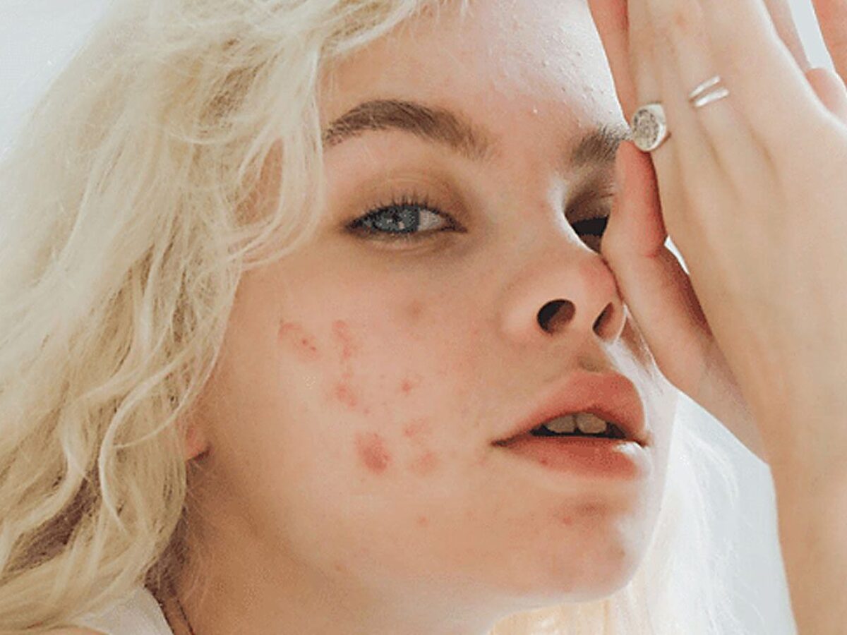 precio roacutan españa