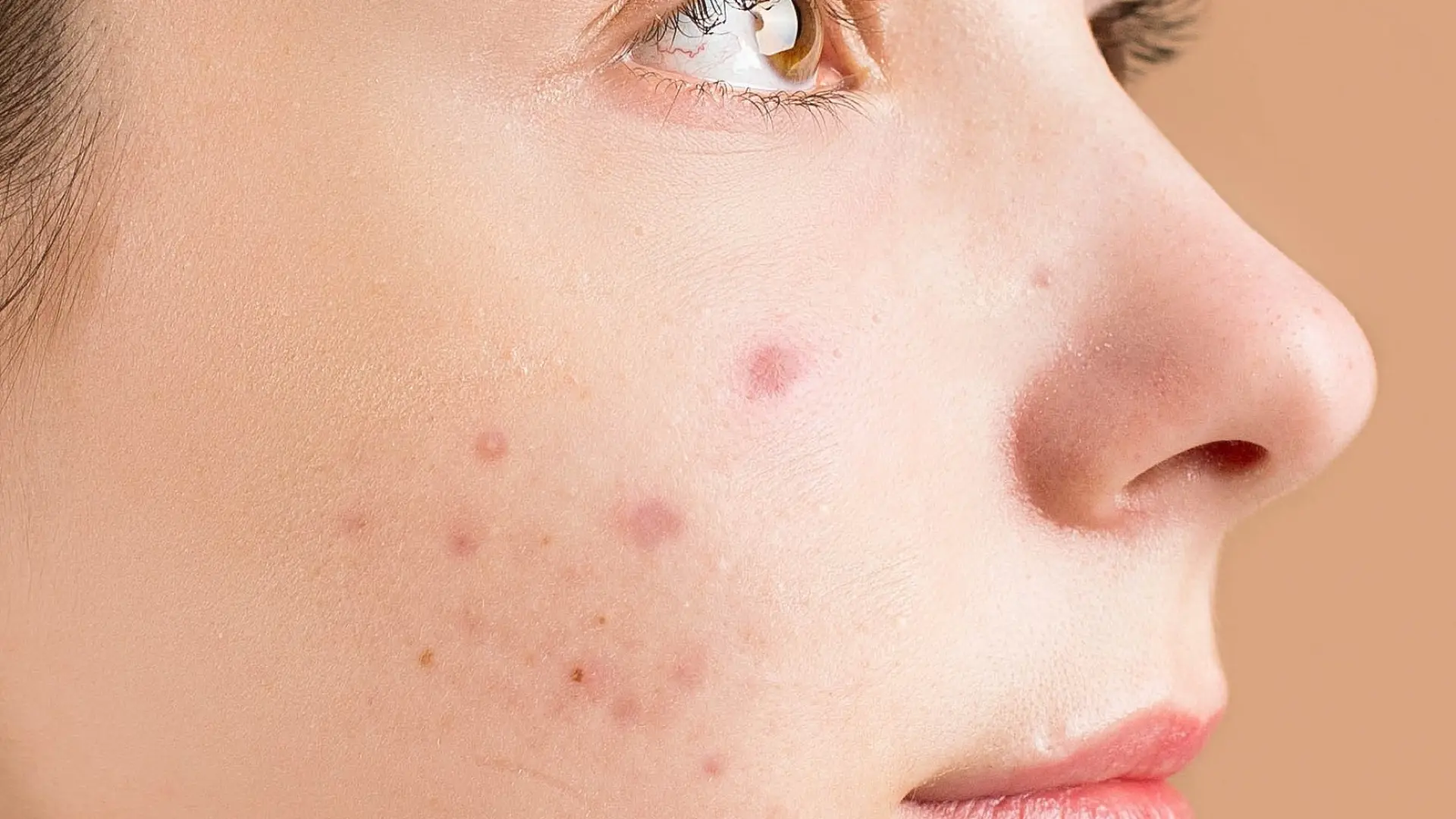 Donde comprar roaccutane