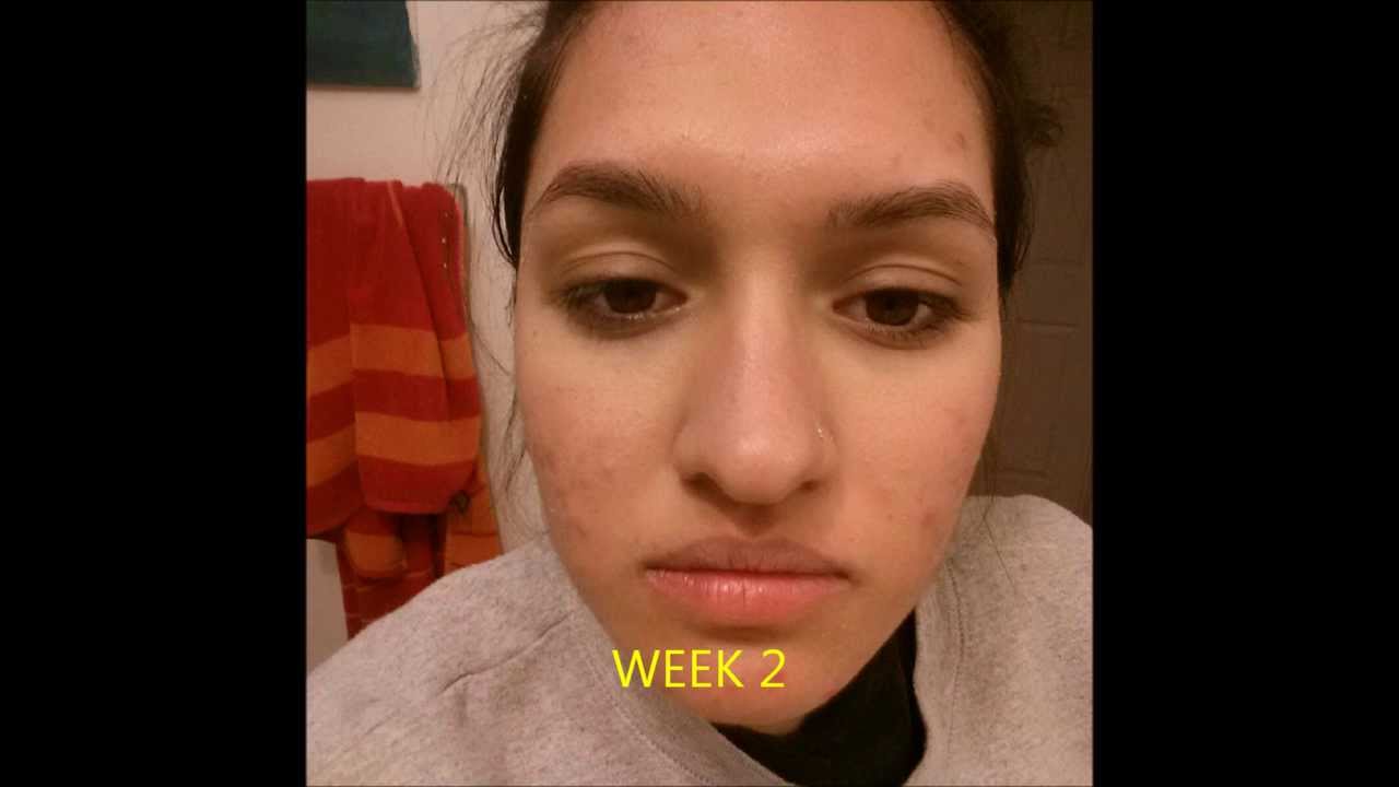 Roaccutane Genéricos