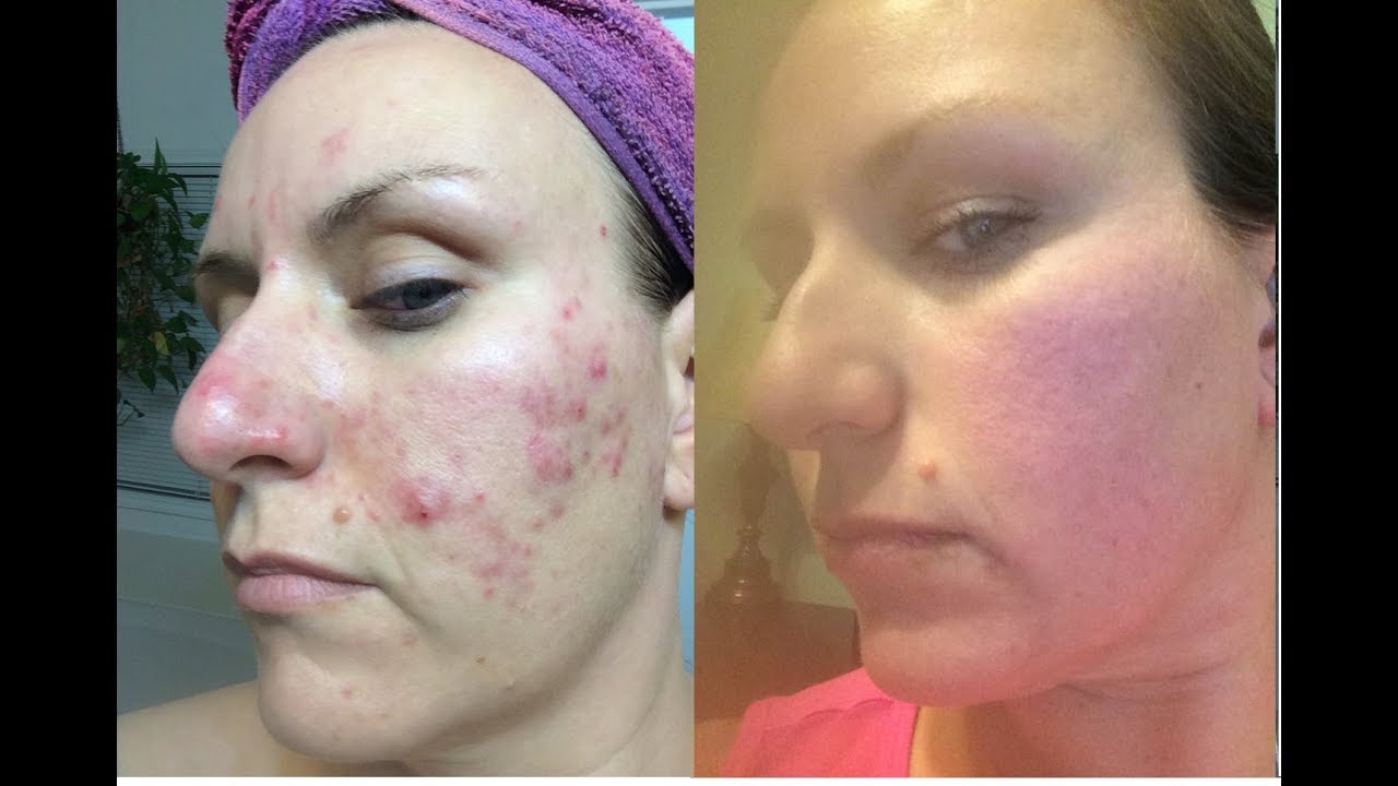 roaccutane 10mg