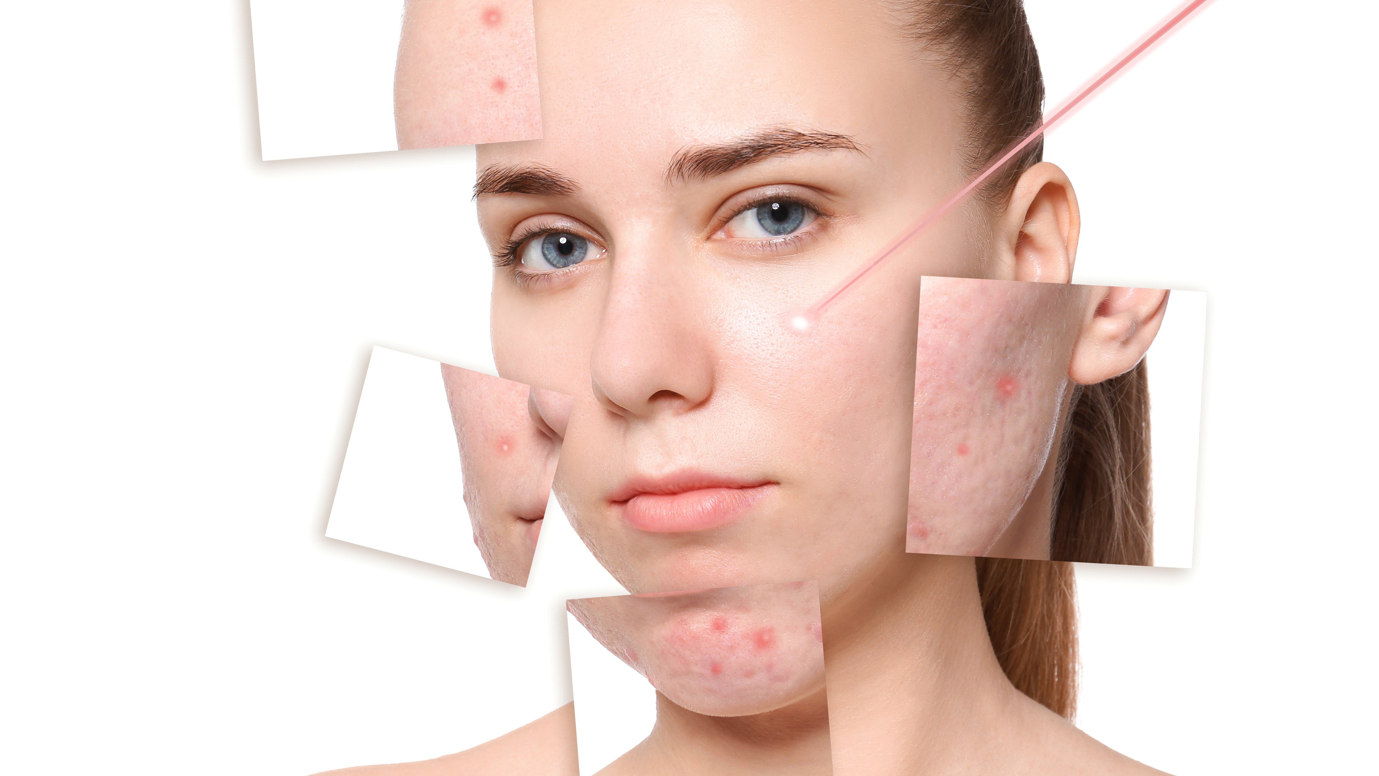 roacutan 40 mg precio