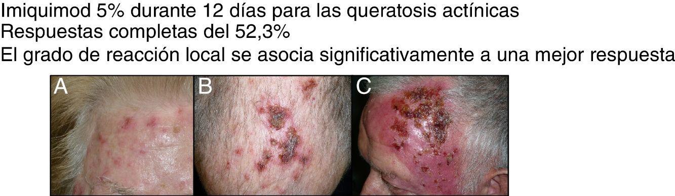 Imiquimod Aldara Precio