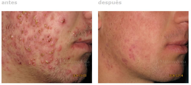 Medicamento roacutan pastillas