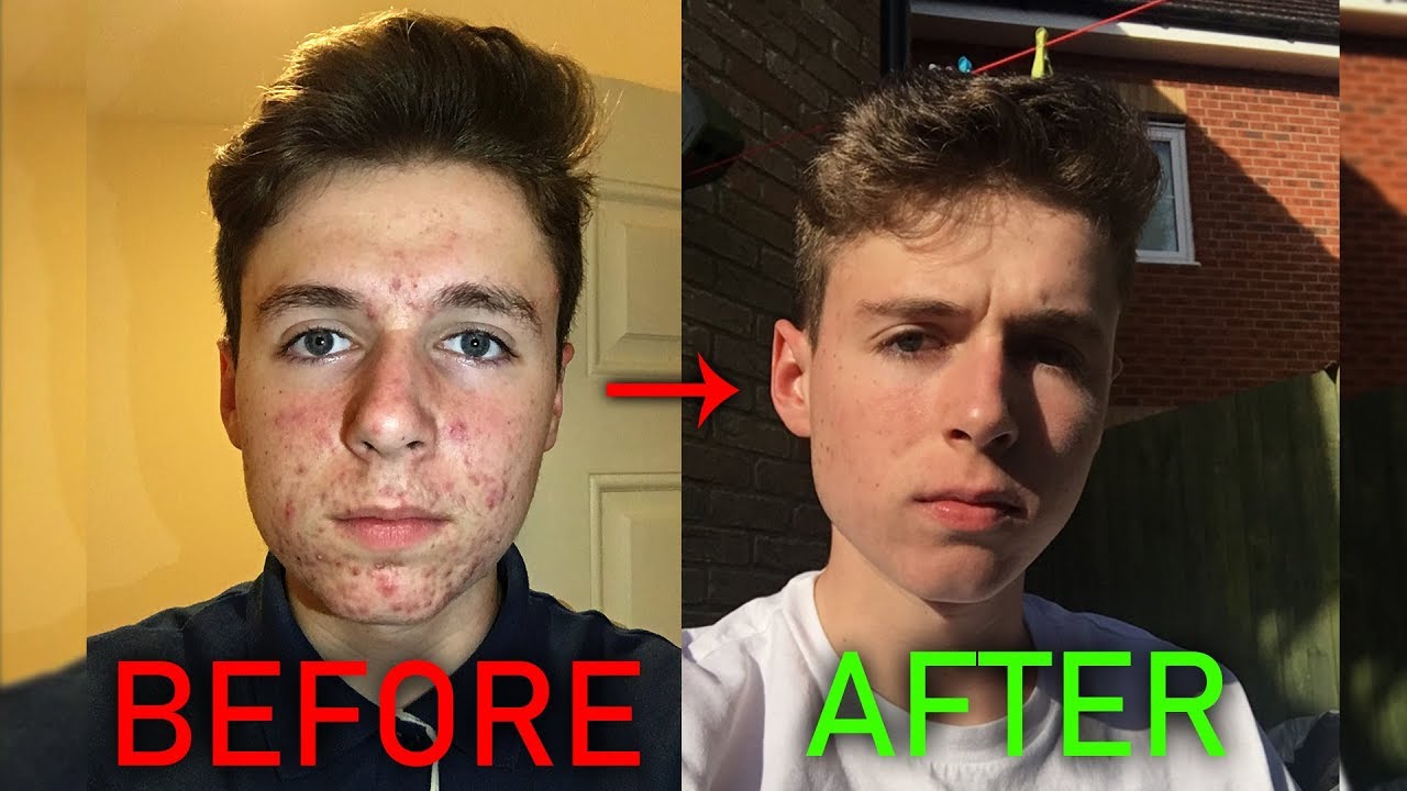 Precio De Accutane