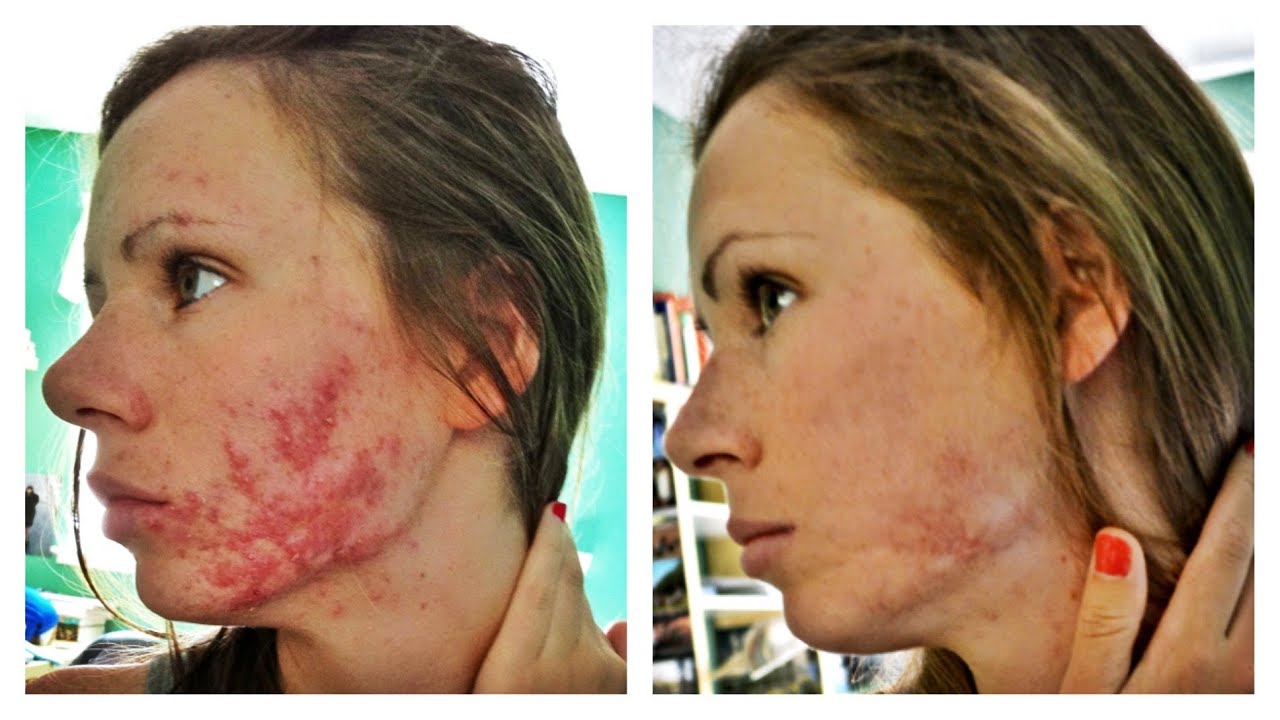 Roaccutane Genéricos