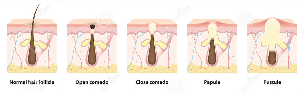 Quanto custa o roacutan genérico