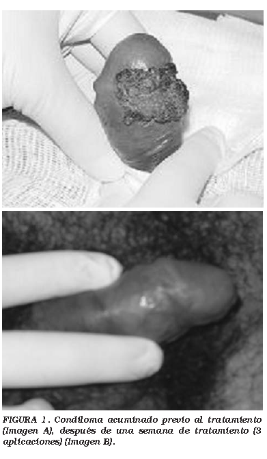 Aldara medicamento precio