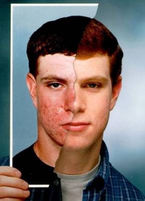 Isotretinoina españa