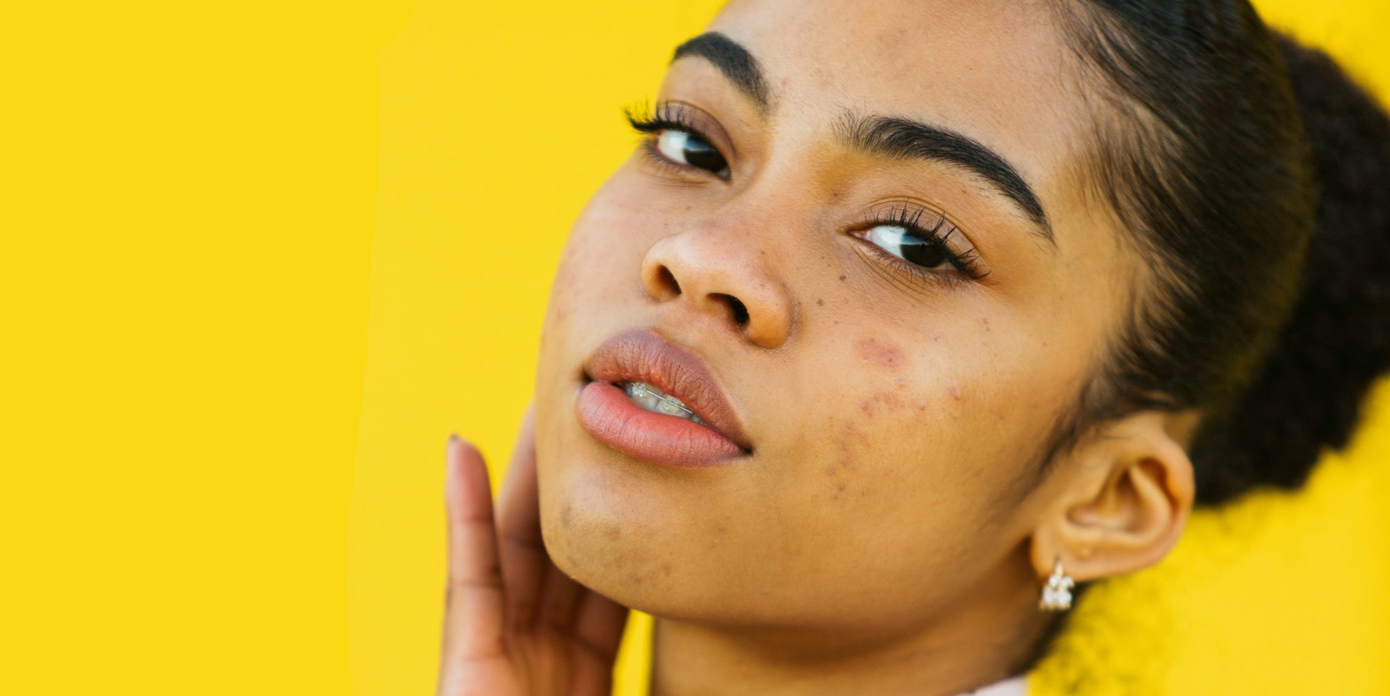 como comprar roacutan