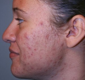 Comprar Roaccutane Generico