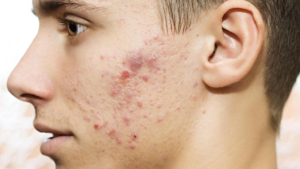 Donde comprar accutane