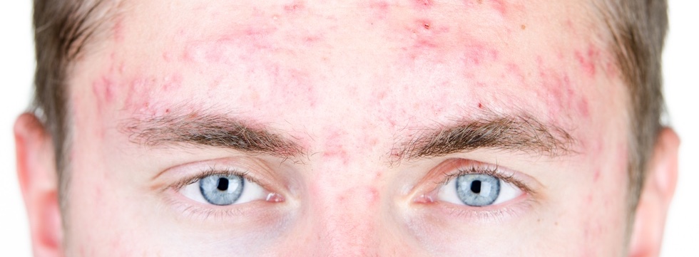 donde puedo comprar roaccutane