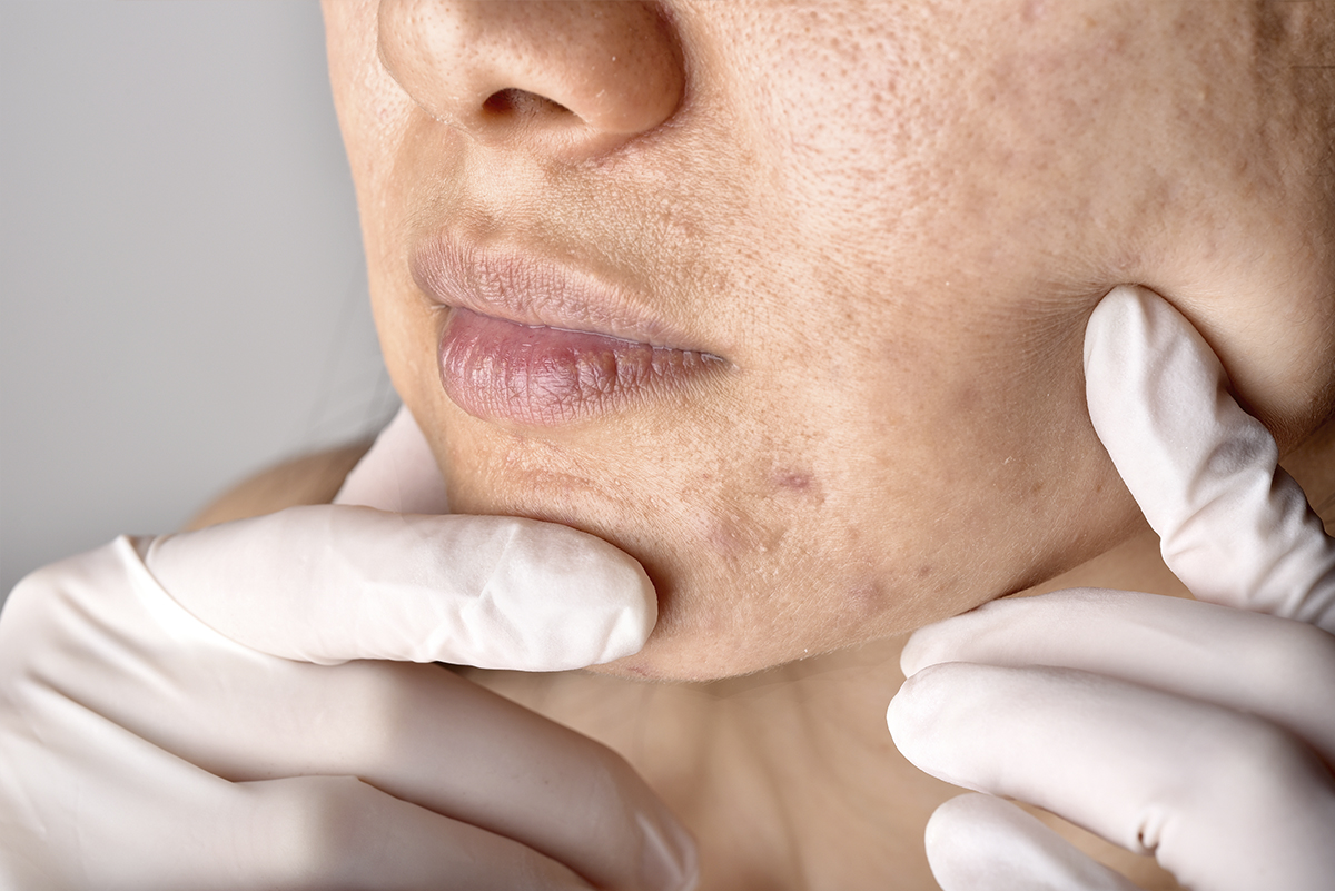 Donde Venden La Isotretinoina