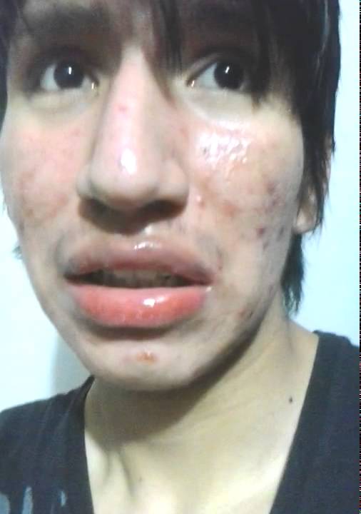 Precio de roacutan en españa