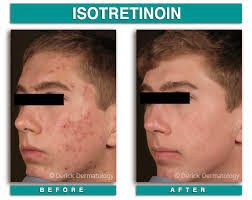 isotretinoin 5mg