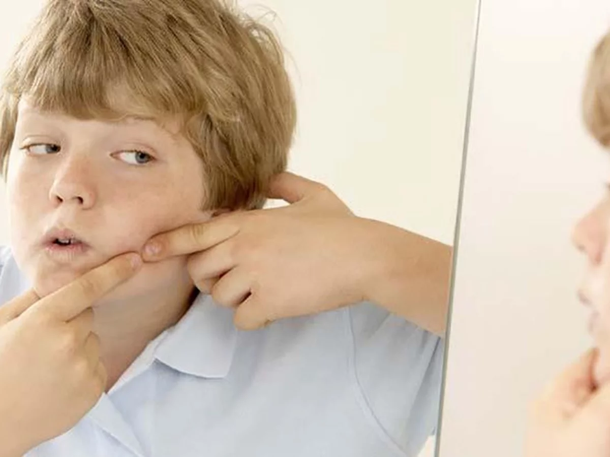 Isotretinoin sin receta