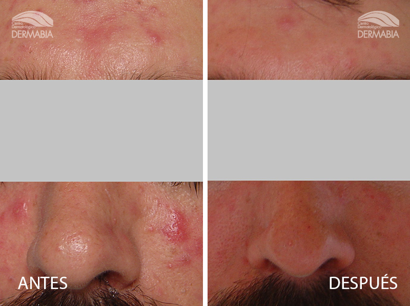 isotretinoina on-line