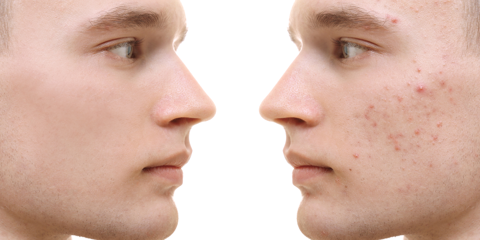 isotretinoina precio mexico