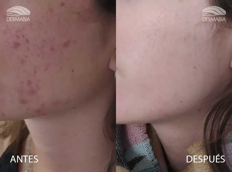 Pastillas Granos Roacutan