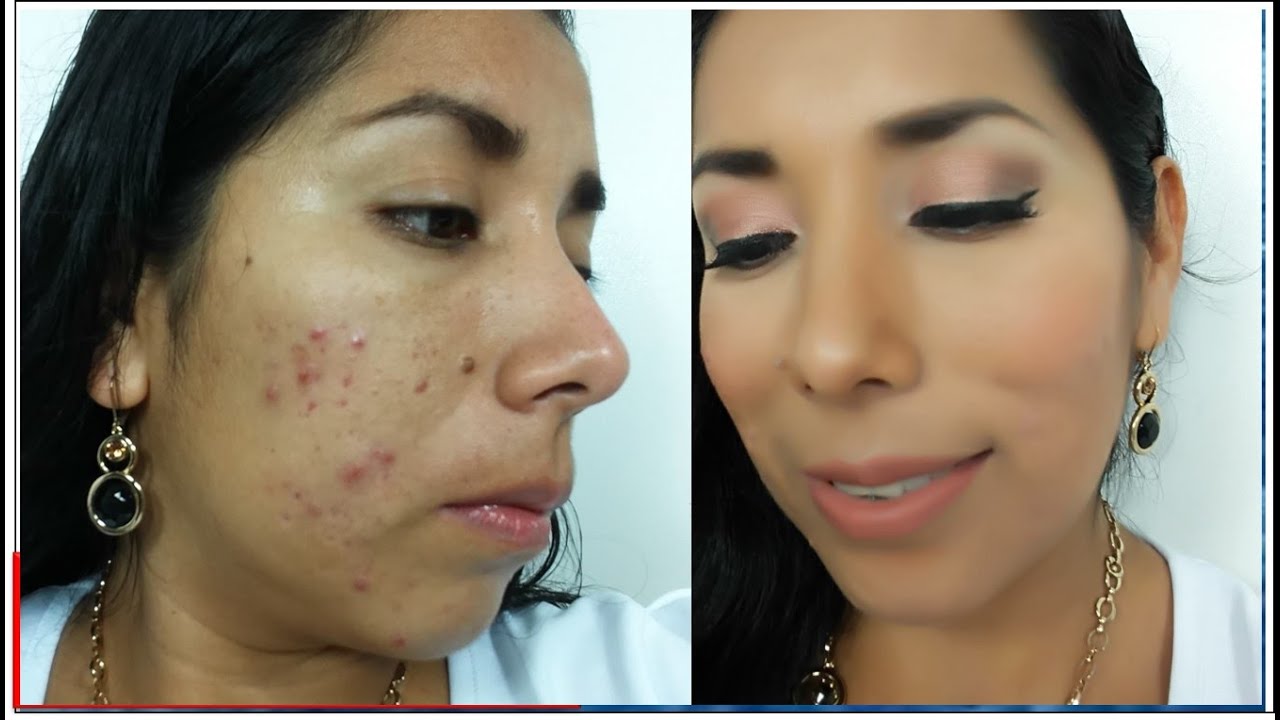 pastillas isoface isotretinoina