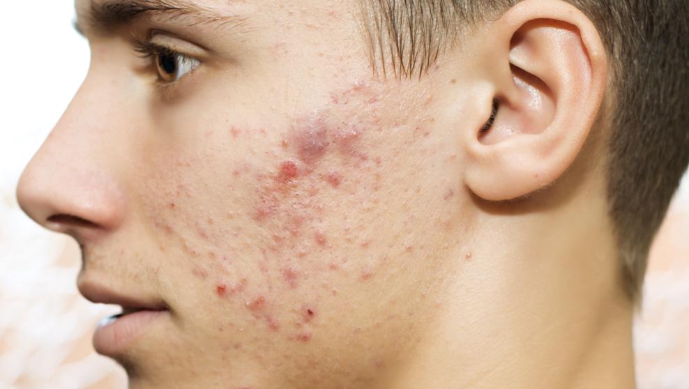 precio roacutan españa