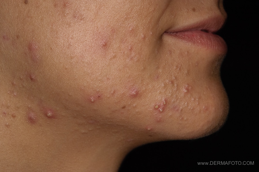 roaccutane 30mg online