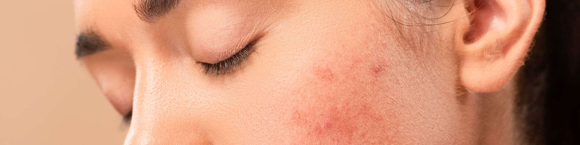 roaccutane comprar online