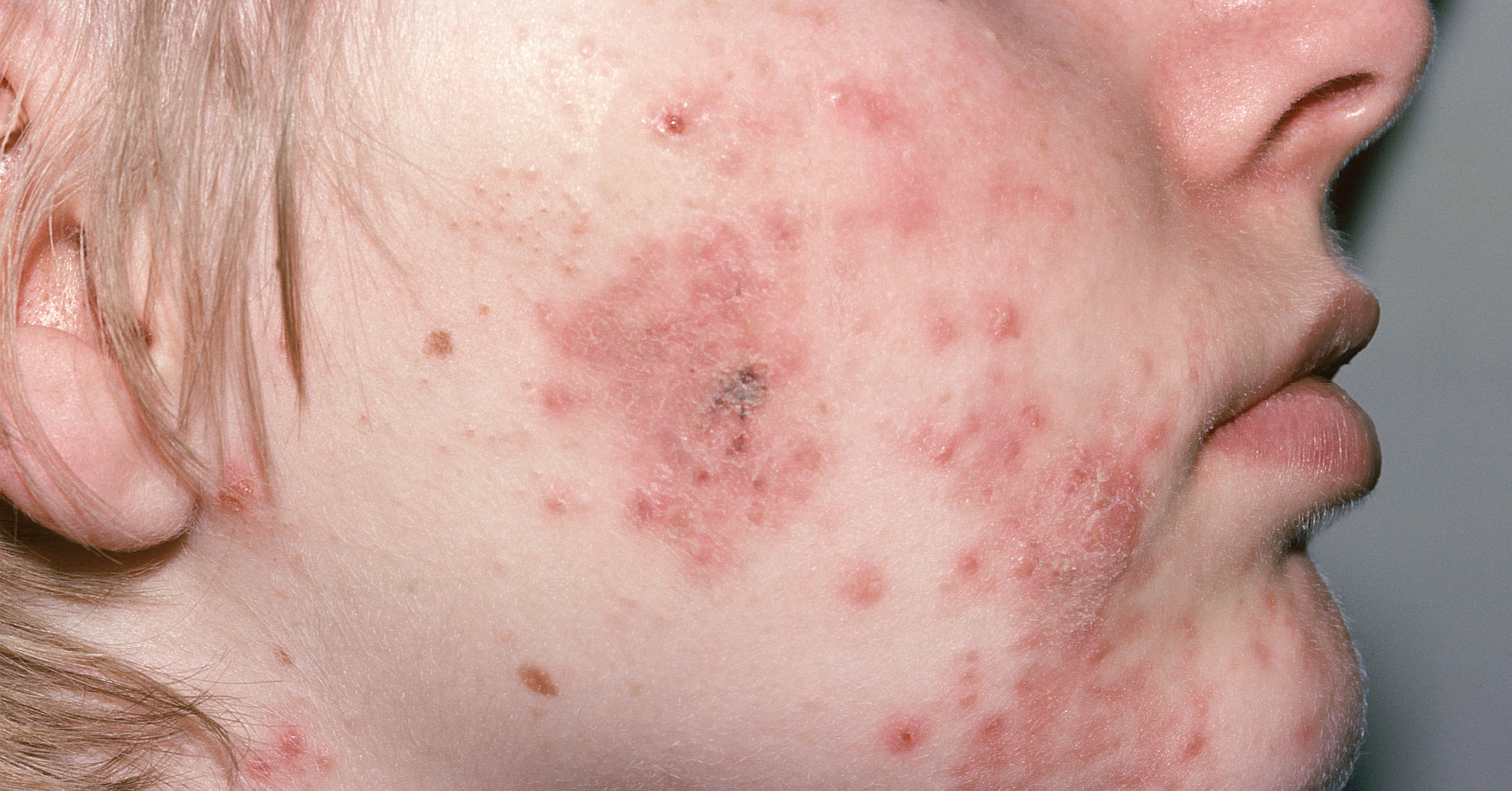 Roaccutane en el mostrador