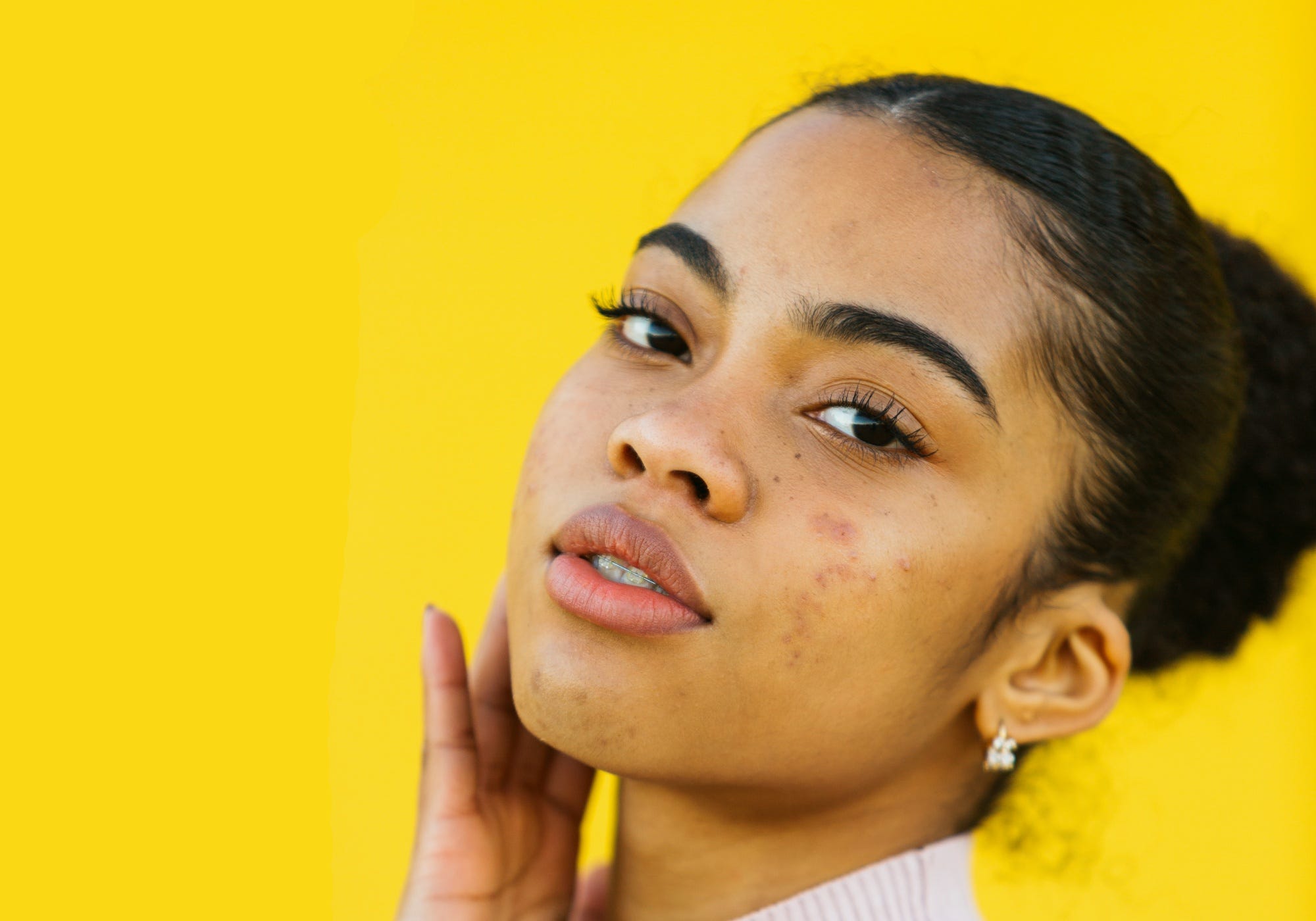 roaccutane sin receta