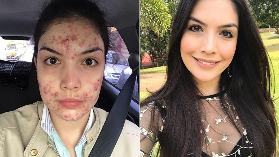 Roacutan 30 Mg Precio