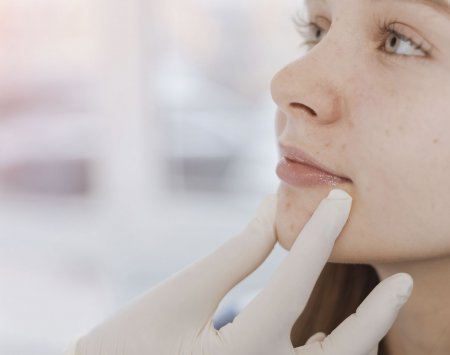 Roacutan Genérico Comprar Online